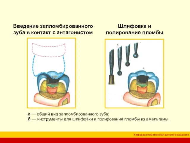 Введение запломбированного зуба в контакт с антагонистом Шлифовка и полирование пломбы а