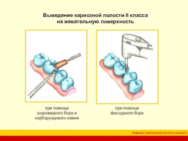 Выведение кариозной полости II класса на жевательную поверхность при помощи фиссурного бора