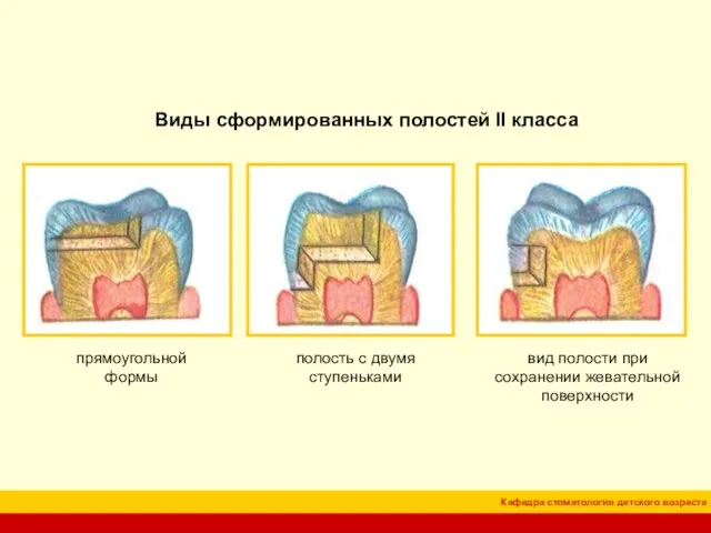 Виды сформированных полостей II класса прямоугольной формы полость с двумя ступеньками вид