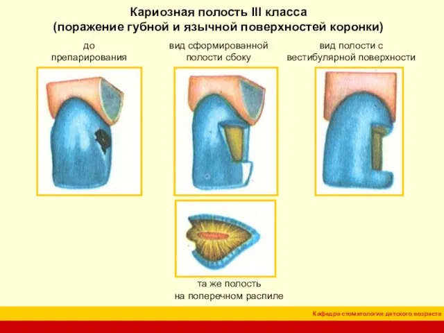 Кариозная полость III класса (поражение губной и язычной поверхностей коронки) до препарирования