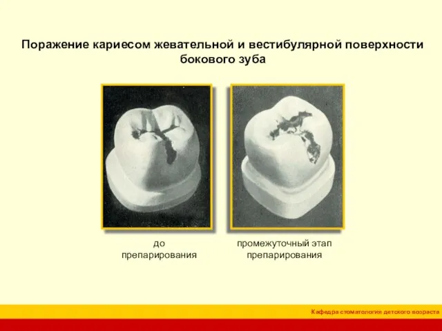 Поражение кариесом жевательной и вестибулярной поверхности бокового зуба до препарирования промежуточный этап препарирования