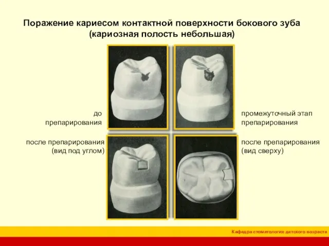 Поражение кариесом контактной поверхности бокового зуба (кариозная полость небольшая) до препарирования промежуточный