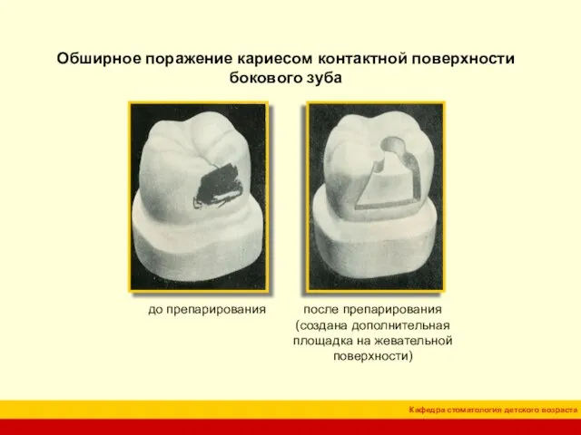 Обширное поражение кариесом контактной поверхности бокового зуба до препарирования после препарирования (создана