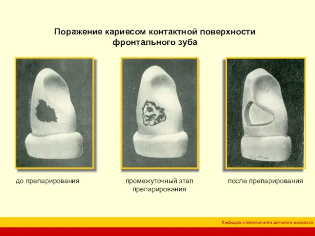 Поражение кариесом контактной поверхности фронтального зуба до препарирования промежуточный этап препарирования после препарирования