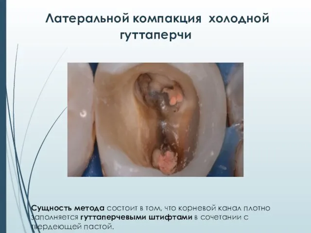 Латеральной компакция холодной гуттаперчи Сущность метода состоит в том, что корневой канал