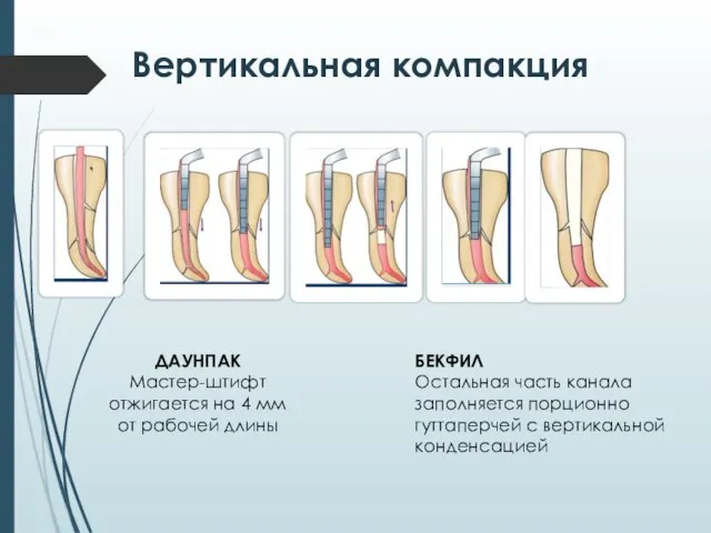 Вертикальная компакция ДАУНПАК Мастер-штифт отжигается на 4 мм от рабочей длины БЕКФИЛ