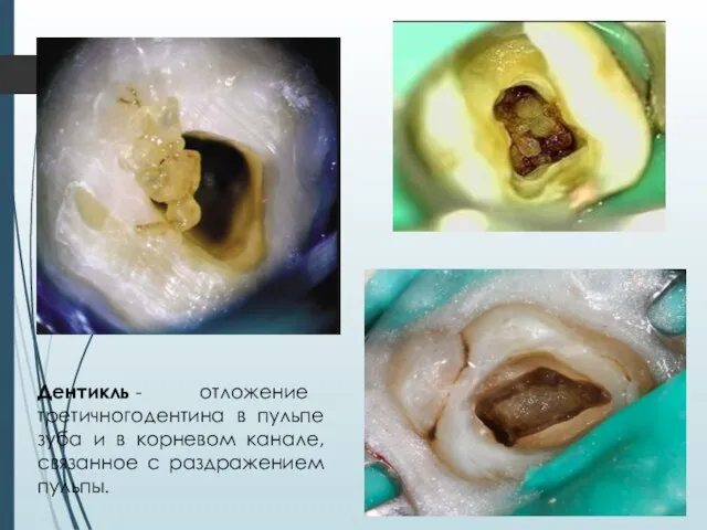 Дентикль - отложение третичногодентина в пульпе зуба и в корневом канале, связанное с раздражением пульпы.