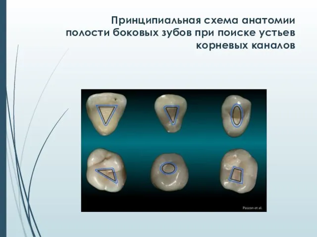 Принципиальная схема анатомии полости боковых зубов при поиске устьев корневых каналов
