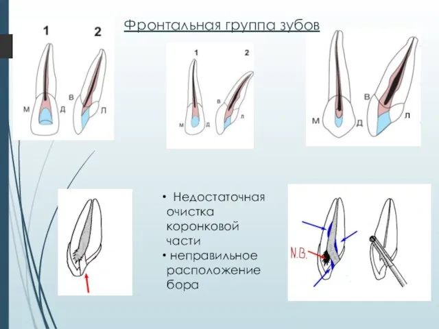 Фронтальная группа зубов Недостаточная очистка коронковой части неправильное расположение бора