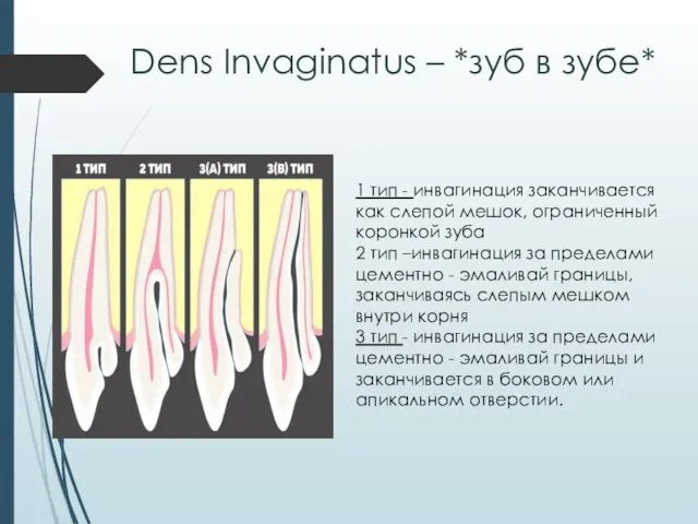 Dens Invaginatus – *зуб в зубе* 1 тип - инвагинация заканчивается как