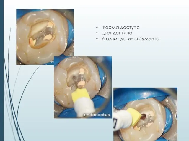 Форма доступа Цвет дентина Угол входа инструмента