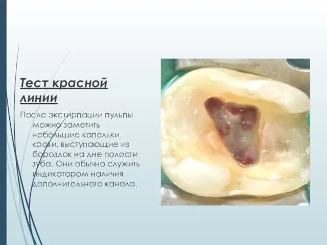 Тест красной линии После экстирпации пульпы можно заметить небольшие капельки крови, выступающие