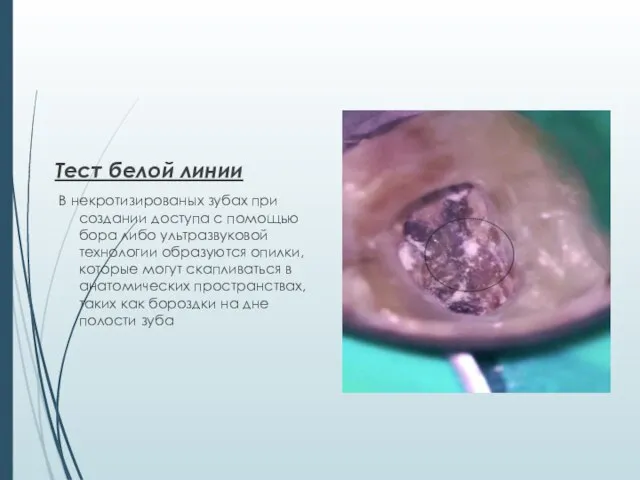 Тест белой линии В некротизированых зубах при создании доступа с помощью бора
