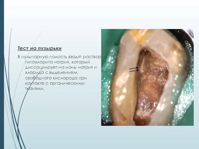 Тест на пузырьки В пульпарную полость вводят раствор гипохлорита натрия, который диссоциирует