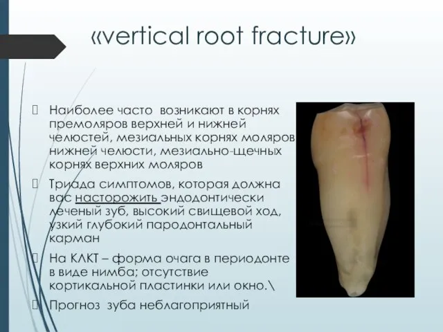 «vertical root fracture» Наиболее часто возникают в корнях премоляров верхней и нижней