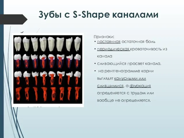 Зубы с S-Shape каналами Признаки: постоянная остаточная боль периодическая кровоточивость из канала