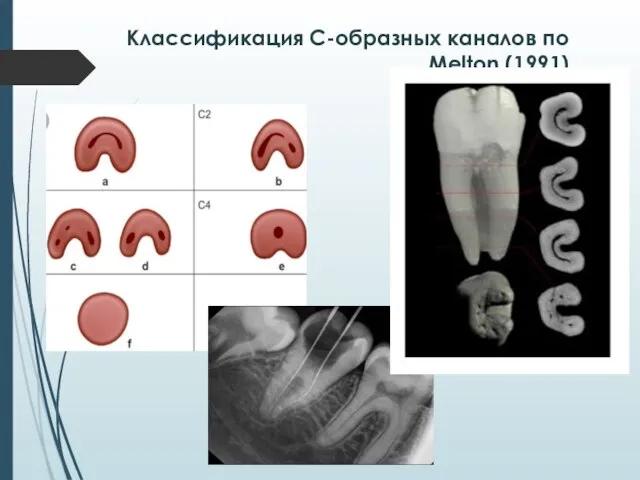 Классификация С-образных каналов по Melton (1991)