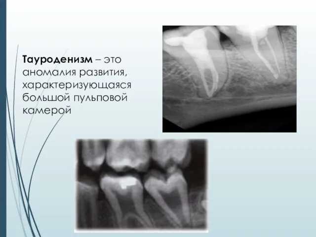 Тауроденизм – это аномалия развития, характеризующаяся большой пульповой камерой