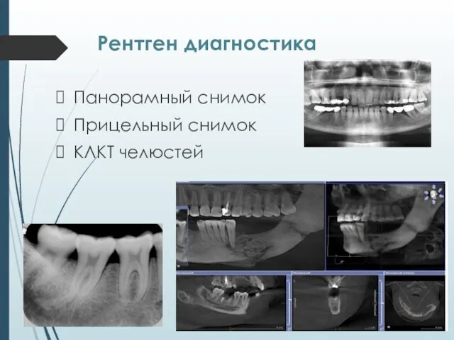 Рентген диагностика Панорамный снимок Прицельный снимок КЛКТ челюстей