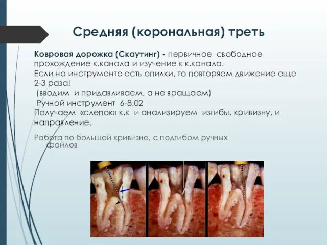 Средняя (корональная) треть Работа по большой кривизне, с подгибом ручных файлов Ковровая