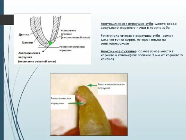 Анатомическая верхушка зуба- место входа сосудисто-нервного пучка в корень зуба Рентгенологическая верхушка