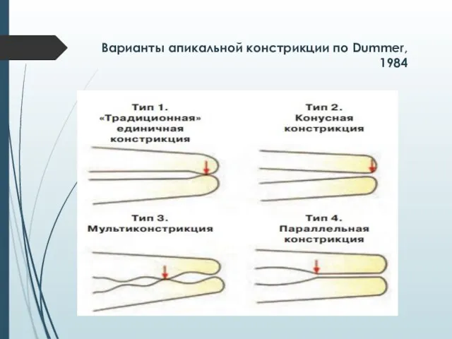 Варианты апикальной констрикции по Dummer, 1984