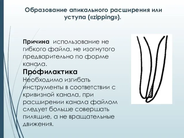 Образование апикального расширения или уступа («zipping»). Причина использование не гибкого файла, не