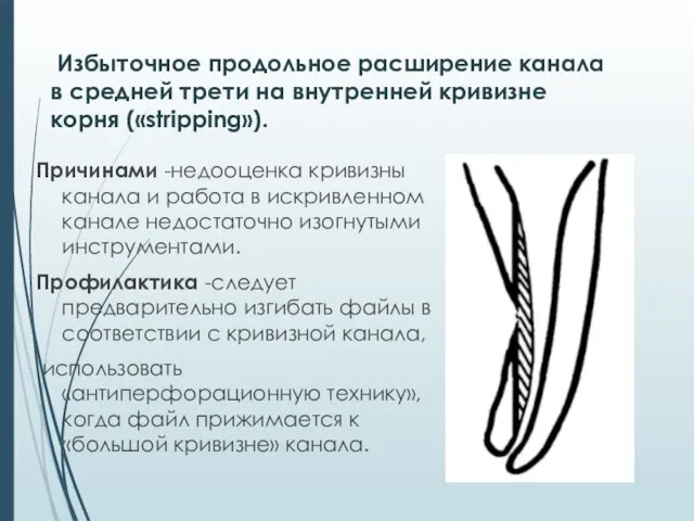 Избыточное продольное расширение канала в средней трети на внутренней кривизне корня («stripping»).