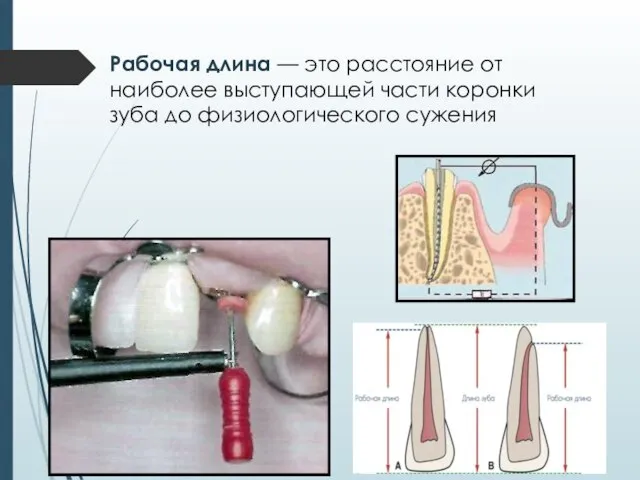 Рабочая длина — это расстояние от наиболее выступающей части коронки зуба до физиологического сужения