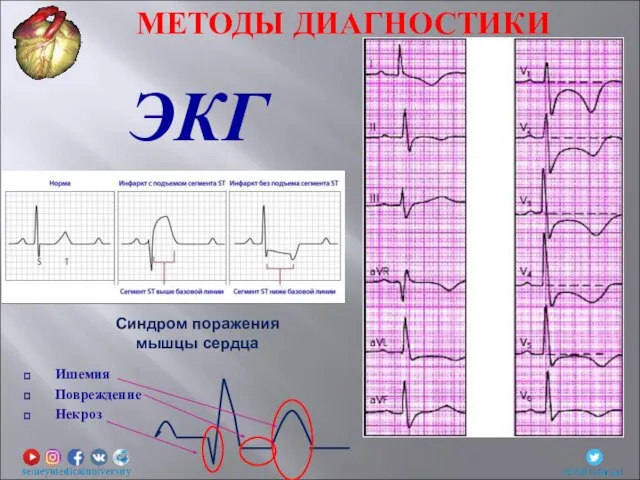 ЭКГ МЕТОДЫ ДИАГНОСТИКИ Ишемия Повреждение Некроз Синдром поражения мышцы сердца