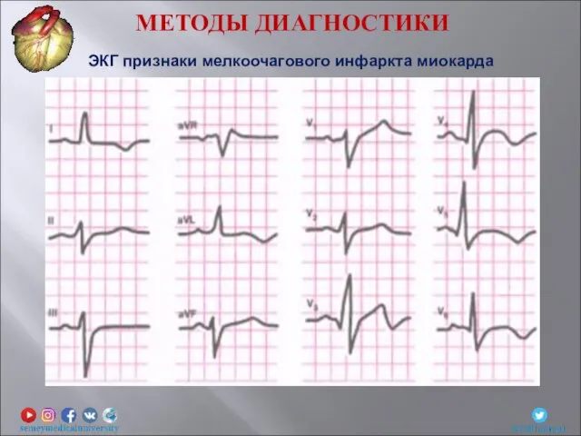 ЭКГ признаки мелкоочагового инфаркта миокарда МЕТОДЫ ДИАГНОСТИКИ