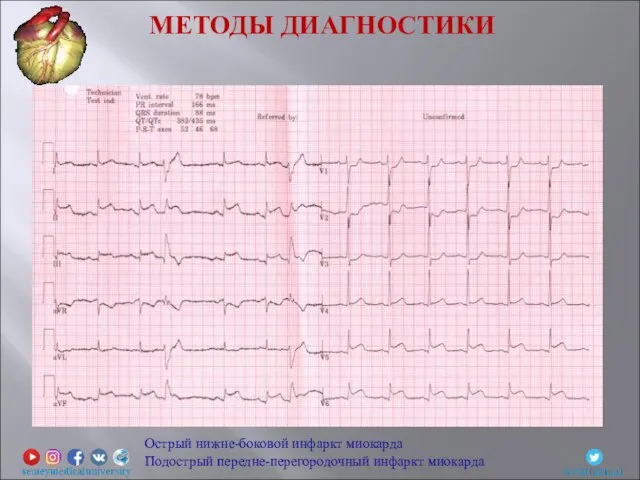 Острый нижне-боковой инфаркт миокарда Подострый передне-перегородочный инфаркт миокарда МЕТОДЫ ДИАГНОСТИКИ