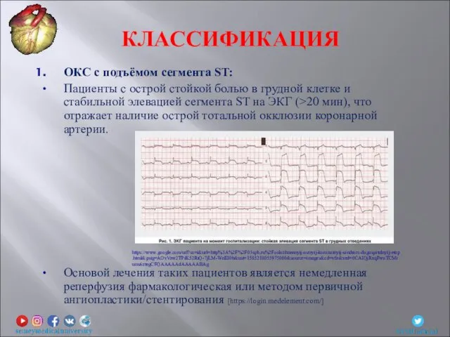 ОКС с подъёмом сегмента ST: Пациенты с острой стойкой болью в грудной