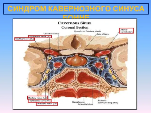 СИНДРОМ КАВЕРНОЗНОГО СИНУСА БОННЕ