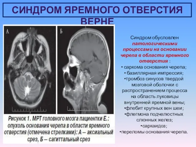 СИНДРОМ ЯРЕМНОГО ОТВЕРСТИЯ ВЕРНЕ Синдром обусловлен патологическими процессами на основании черепа в