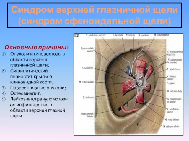 Синдром верхней глазничной щели (синдром сфеноидальной щели) Основные причины: Опухоли и гиперостозы