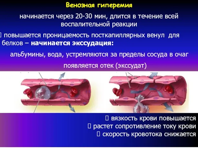 Венозная гиперемия начинается через 20-30 мин, длится в течение всей воспалительной реакции