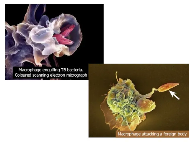 Macrophage engulfing TB bacteria. Coloured scanning electron micrograph Macrophage attacking a foreign body