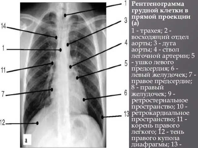 Рентгенограмма грудной клетки в прямой проекции (а) 1 - трахея; 2 -