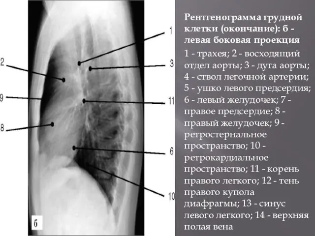 Рентгенограмма грудной клетки (окончание): б - левая боковая проекция 1 - трахея;