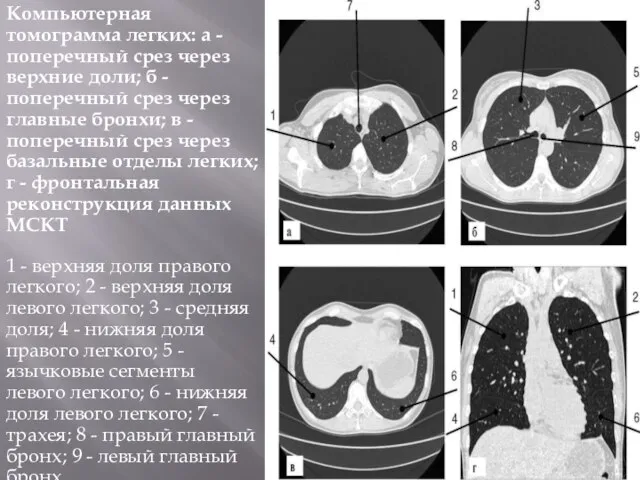 Компьютерная томограмма легких: а - поперечный срез через верхние доли; б -