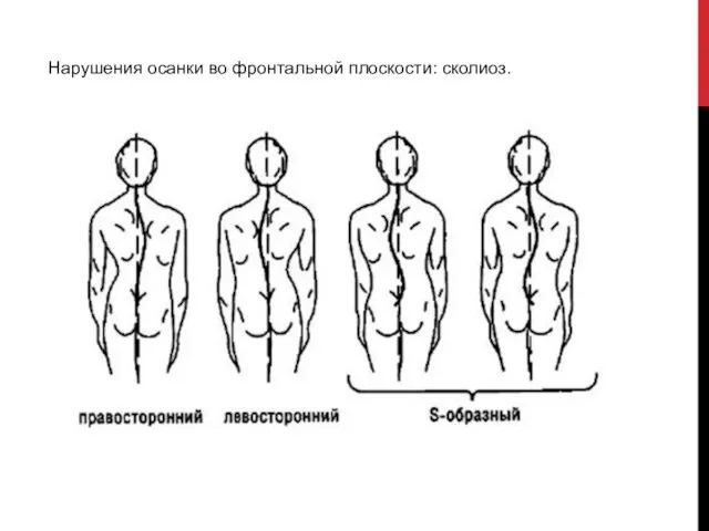 Нарушения осанки во фронтальной плоскости: сколиоз.