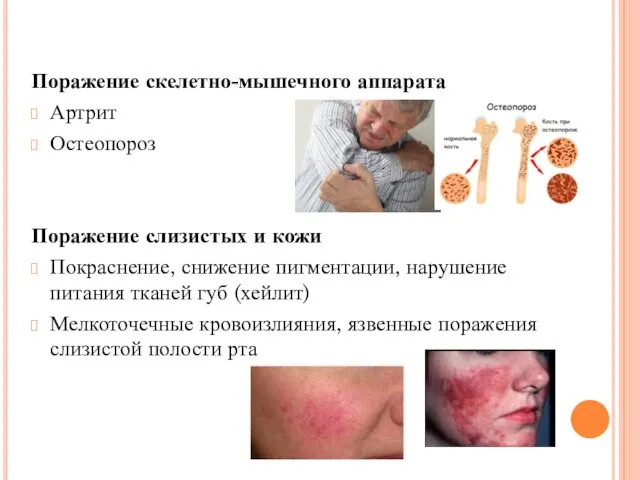 Поражение скелетно-мышечного аппарата Артрит Остеопороз Поражение слизистых и кожи Покраснение, снижение пигментации,