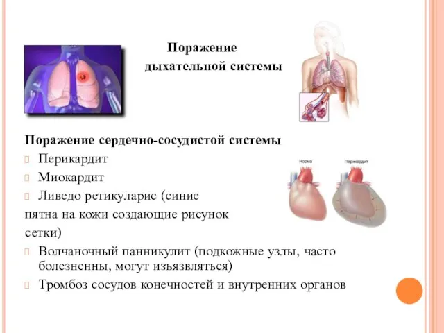 Поражение дыхательной системы Поражение сердечно-сосудистой системы Перикардит Миокардит Ливедо ретикуларис (синие пятна