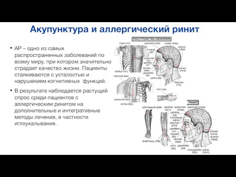 Акупунктура и аллергический ринит АР – одно из самых распространенных заболеваний по