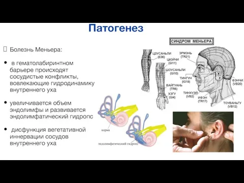 Патогенез Болезнь Меньера: в гематолабиринтном барьере происходят сосудистые конфликты, вовлекающие гидродинамику внутреннего