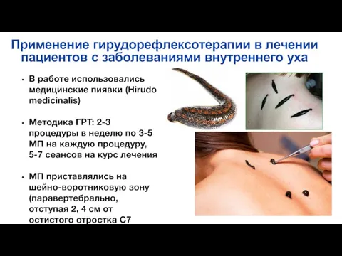 В работе использовались медицинские пиявки (Hirudo medicinalis) Методика ГРТ: 2-3 процедуры в