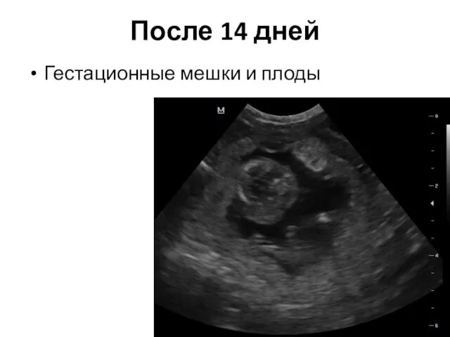 После 14 дней Гестационные мешки и плоды