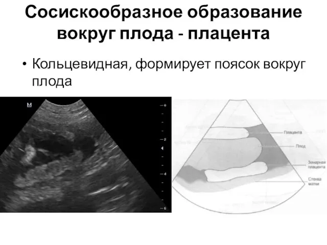 Сосискообразное образование вокруг плода - плацента Кольцевидная, формирует поясок вокруг плода