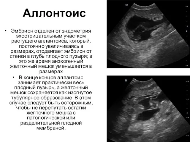 Аллонтоис Эмбрион отделен от эндометрия эхоотрицательным участком растущего аллантоиса, который, постоянно увеличиваясь